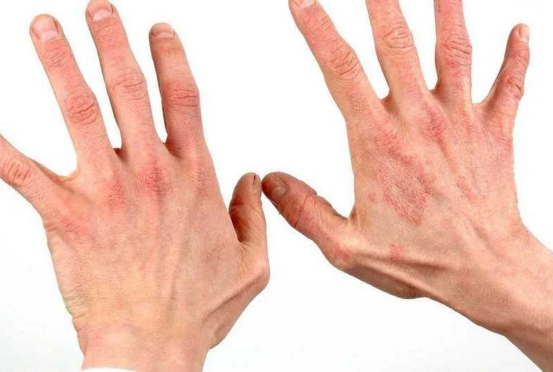 Симптомы дерматита кистей рук