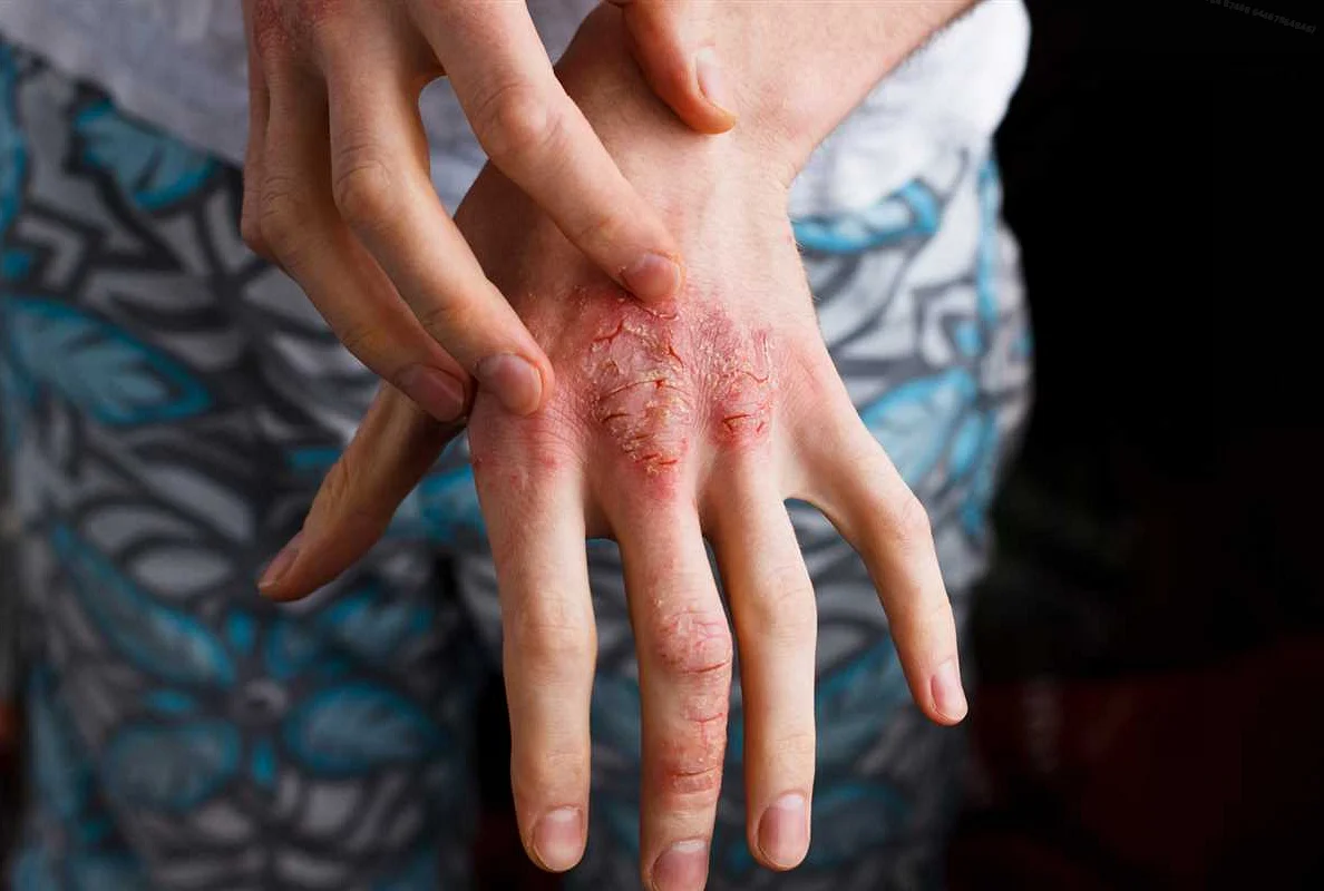 Что такое дерматит кистей рук?