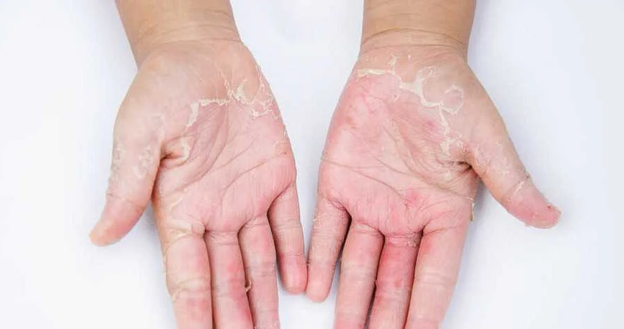 Лечение дерматита кистей рук