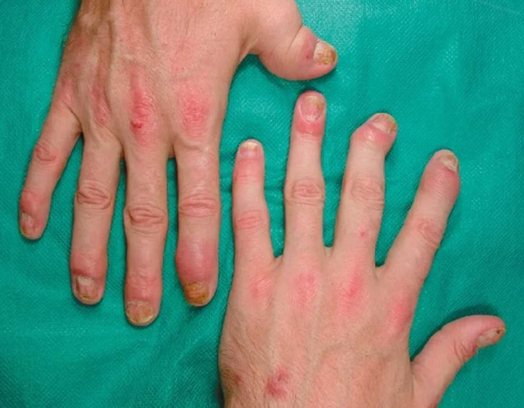 Причины возникновения дерматита кистей рук