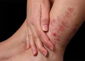 Советы по уходу за кожей при дерматите на ногах