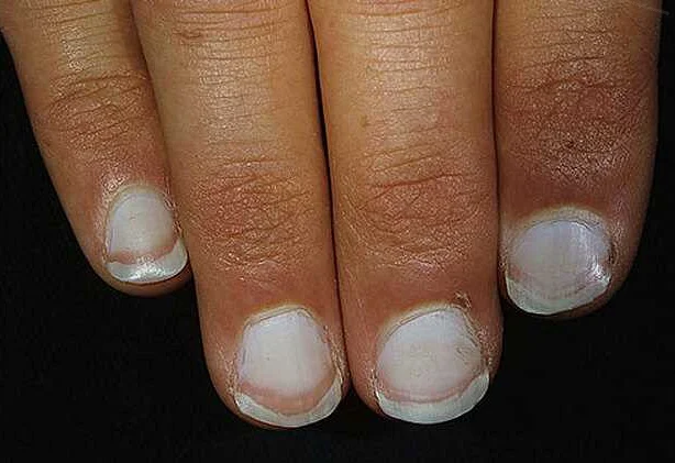 Симптомы и лечение псориаза ногтей