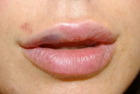 Медицинское лечение гематомы на губах
