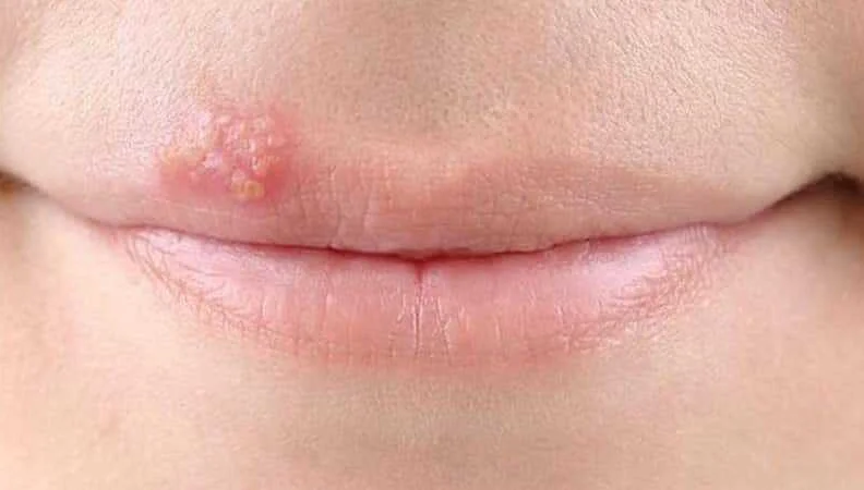 Какие методы лечения герпеса на губах и языке существуют?