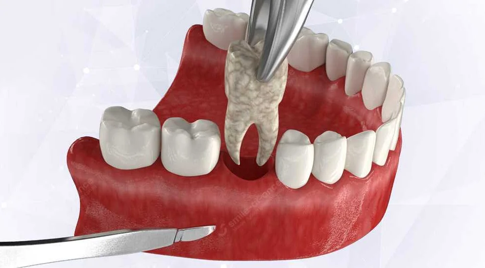 Последствия герпеса после удаления зуба