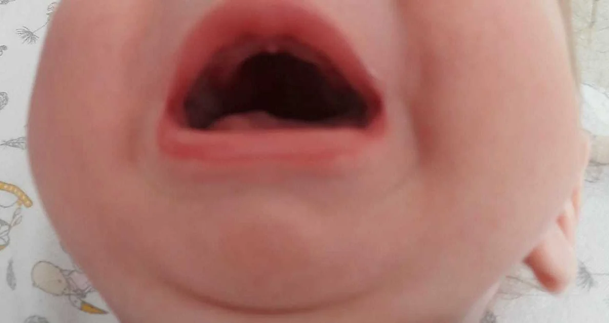Методы лечения глубокого нёба у ребенка