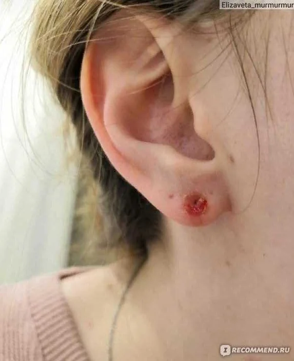 Профилактика гноя в ране после прокола уха