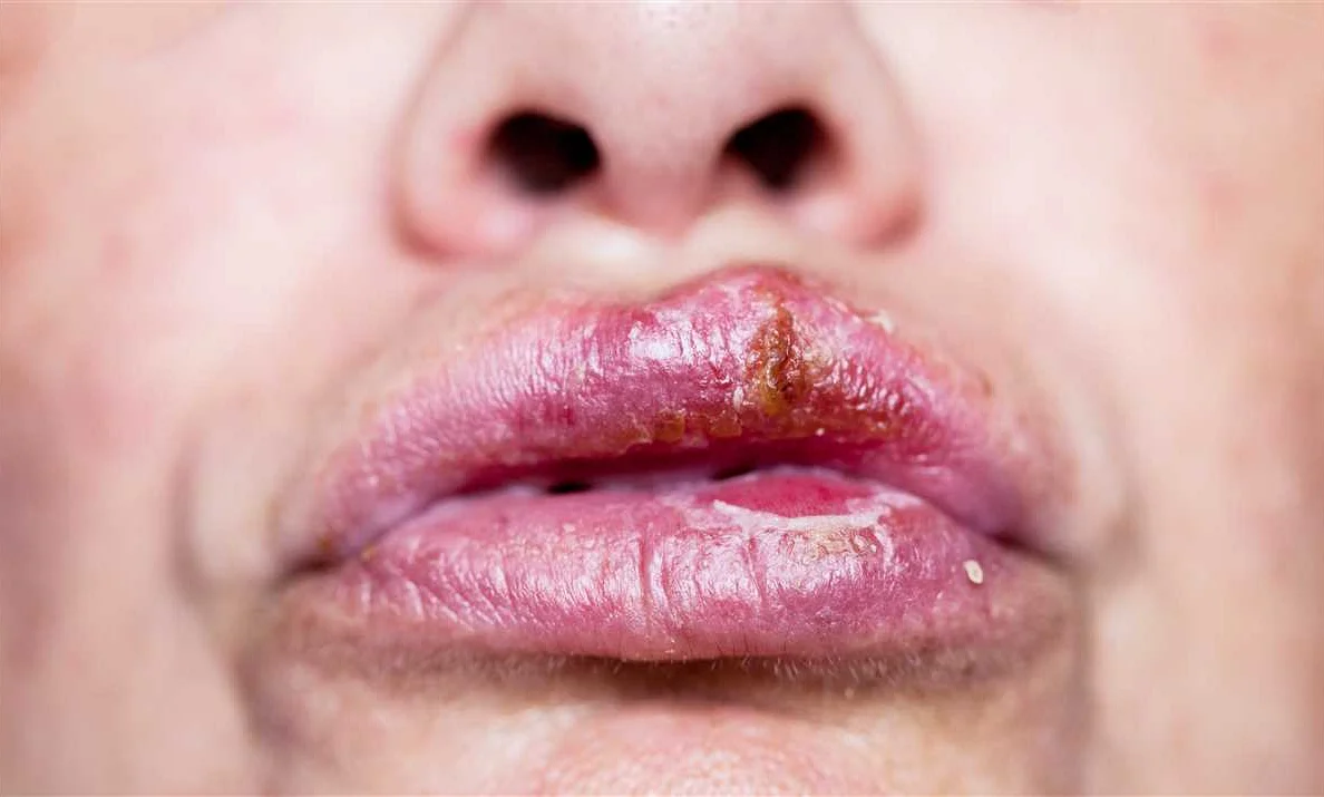 Возможные осложнения гнойной болячки на губе