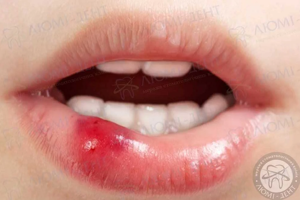 Симптомы гнойной болячки на губе