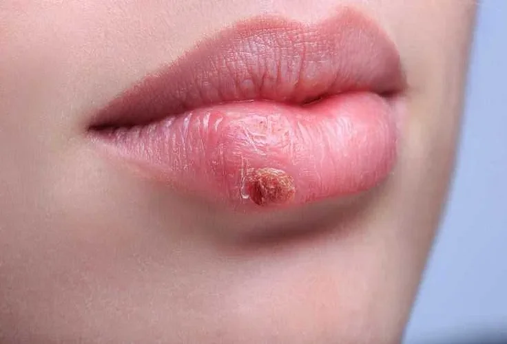 Что такое гнойная болячка на губе?