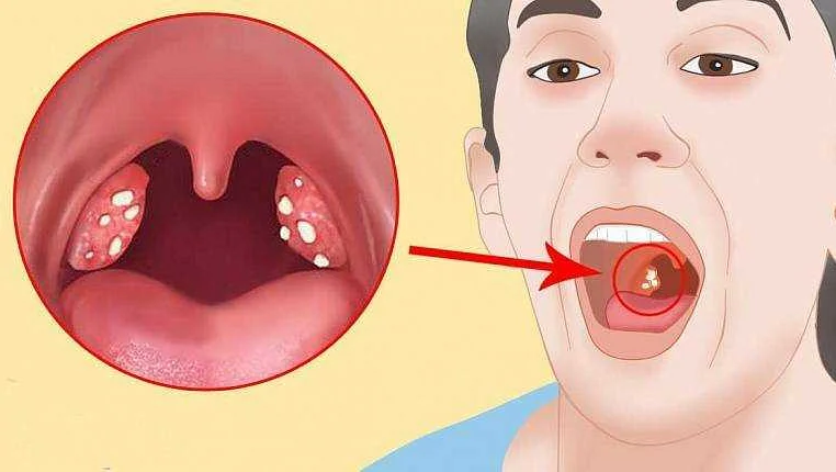 Методы лечения гнойничков в горле