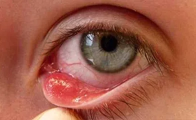 Последствия грибковой инфекции глаз