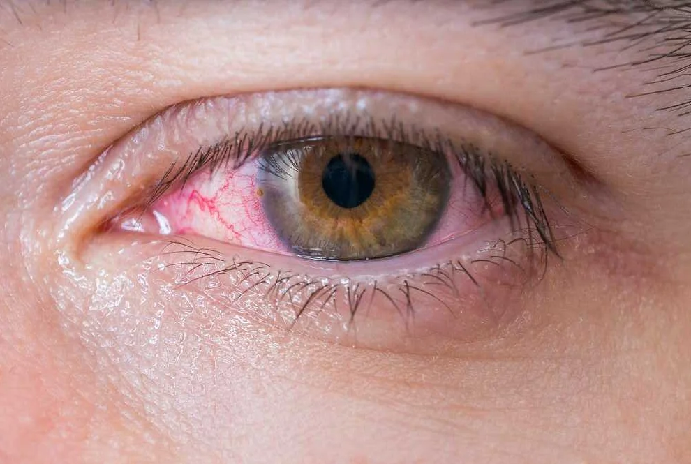 Хроническая грибковая инфекция глаз