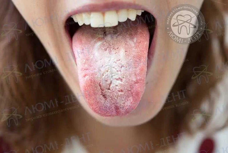 Последствия грибковой инфекции во рту