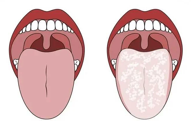 Методы лечения грибковой инфекции во рту