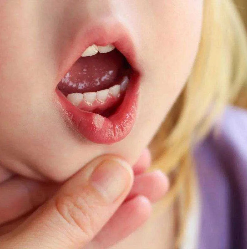 Симптомы грибкового стоматита у детей