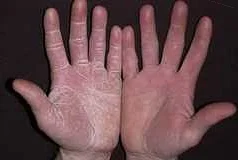 Симптомы грибка на кистях рук