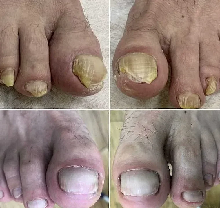 Грибок на ногтях ног: основная информация