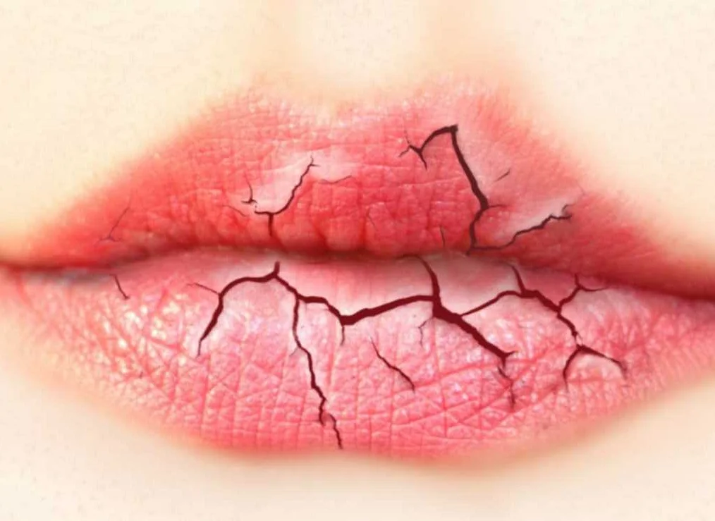 Профилактика трескающихся губ
