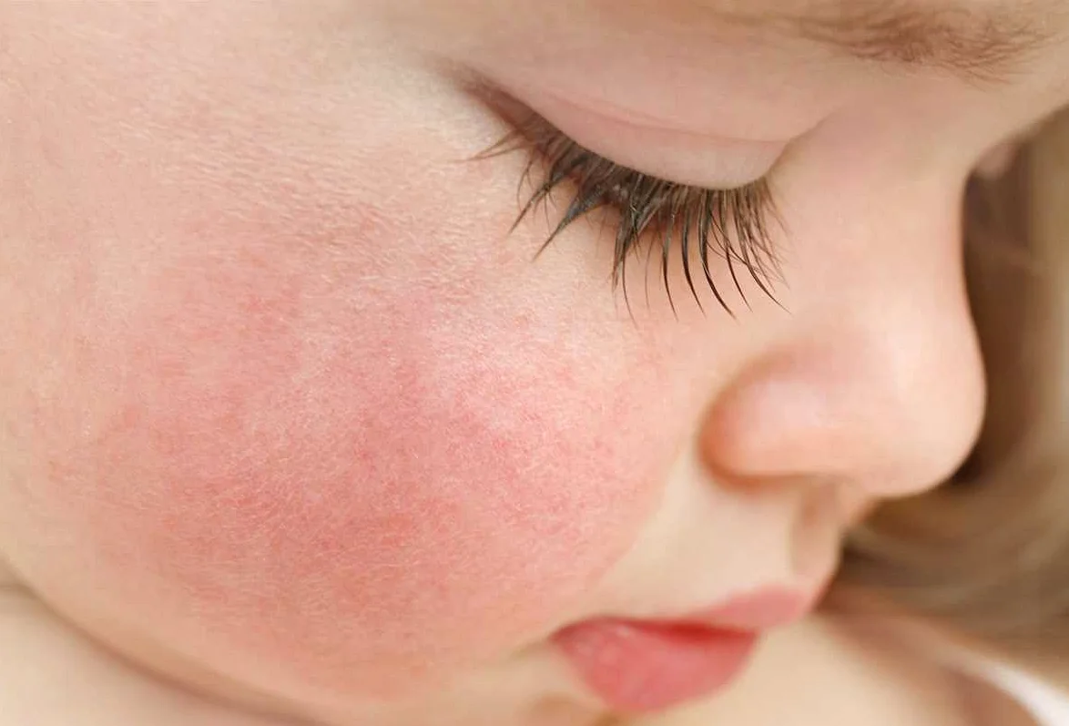 Описание детской аллергии