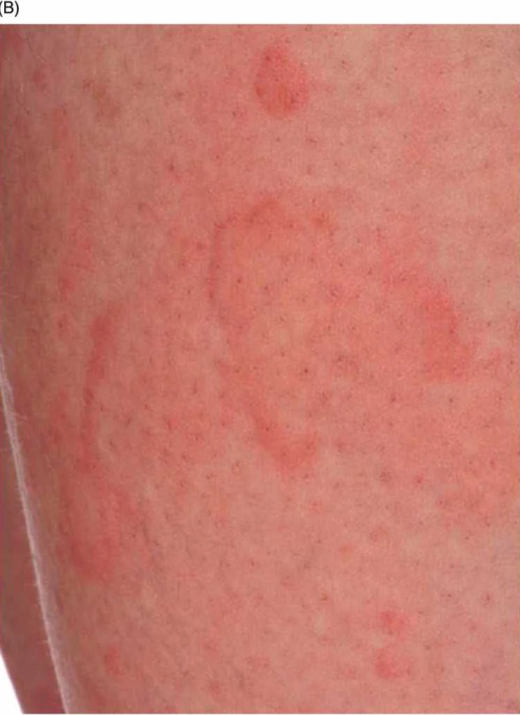 Инфекционные заболевания как причина красных пятен