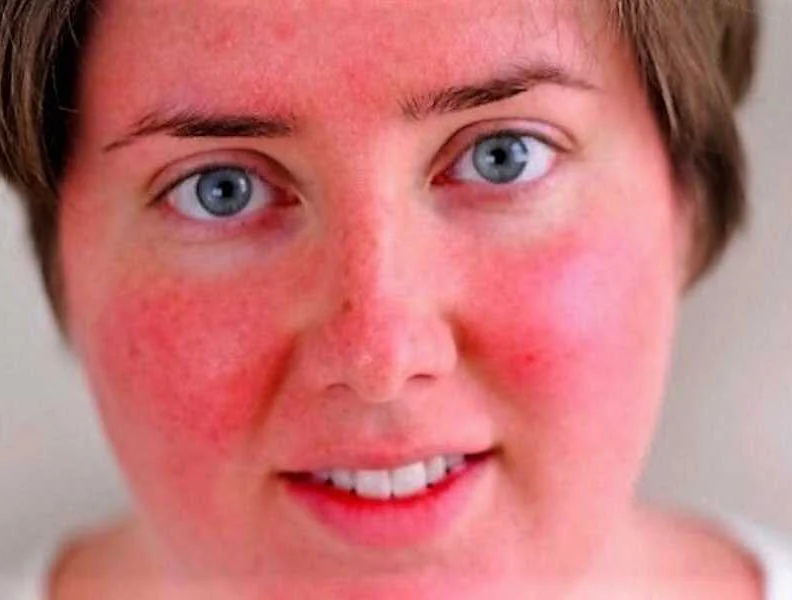 Последствия жара и покраснения кожи