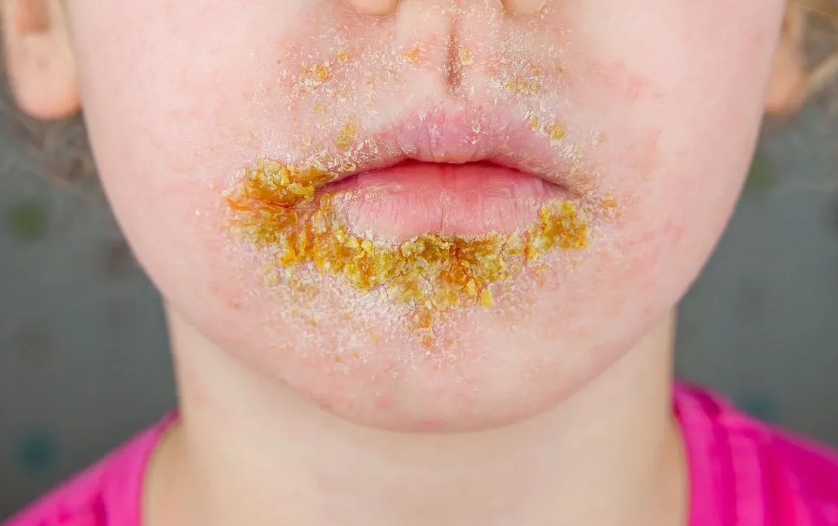 Продукты, которые помогают избежать желтых пятен на губах