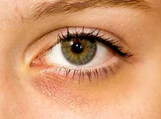 Причины желтизны вокруг глаз у женщин