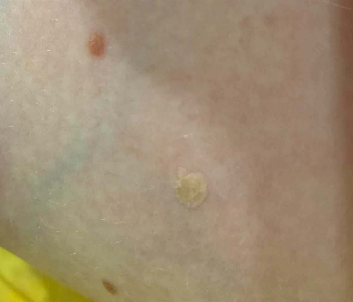 Заболевания, сопровождающиеся желтыми пятнами на коже