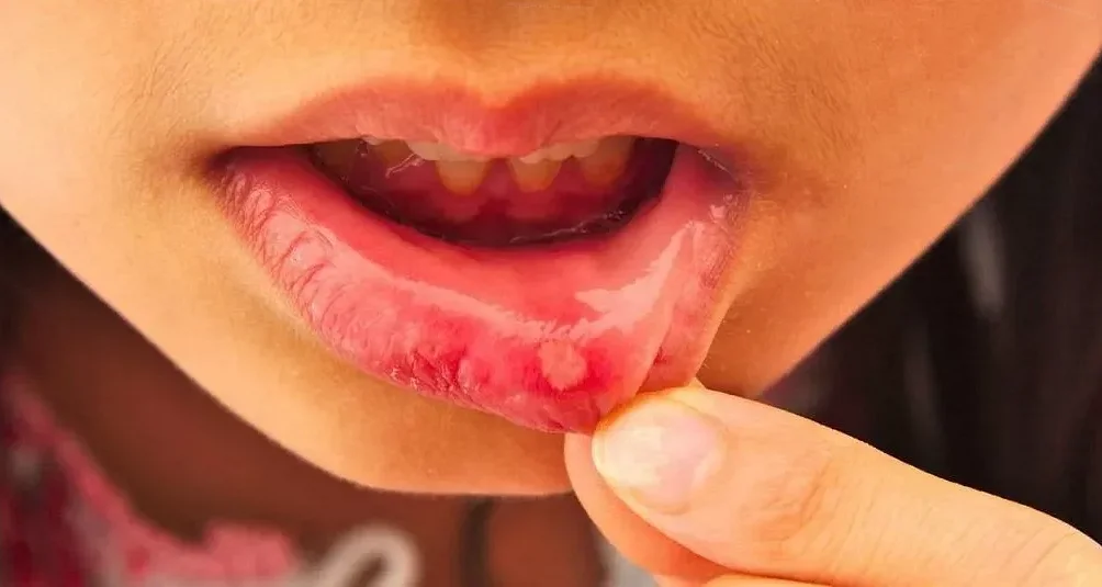 Предупреждение возникновения жжения на губах и языке