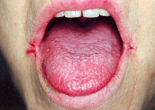Сухость во рту: причина жжения языка и трещин в уголках губ