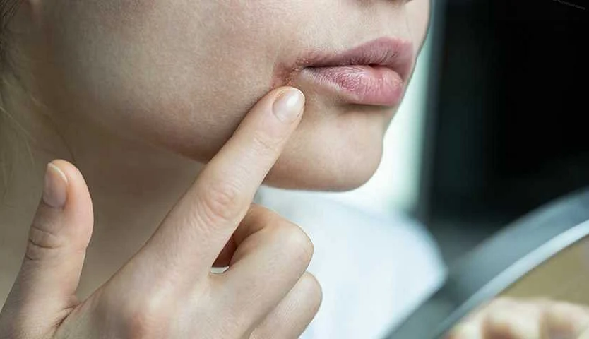 Механические повреждения: почему язык жжется и уголки губ трескаются