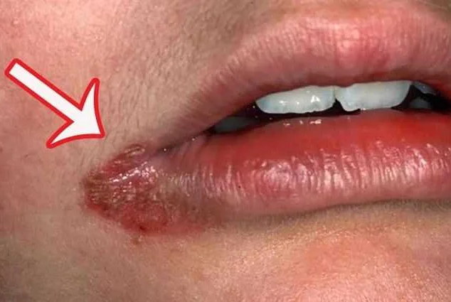 Как решить проблему: советы по устранению жжения языка и трещин в уголках губ